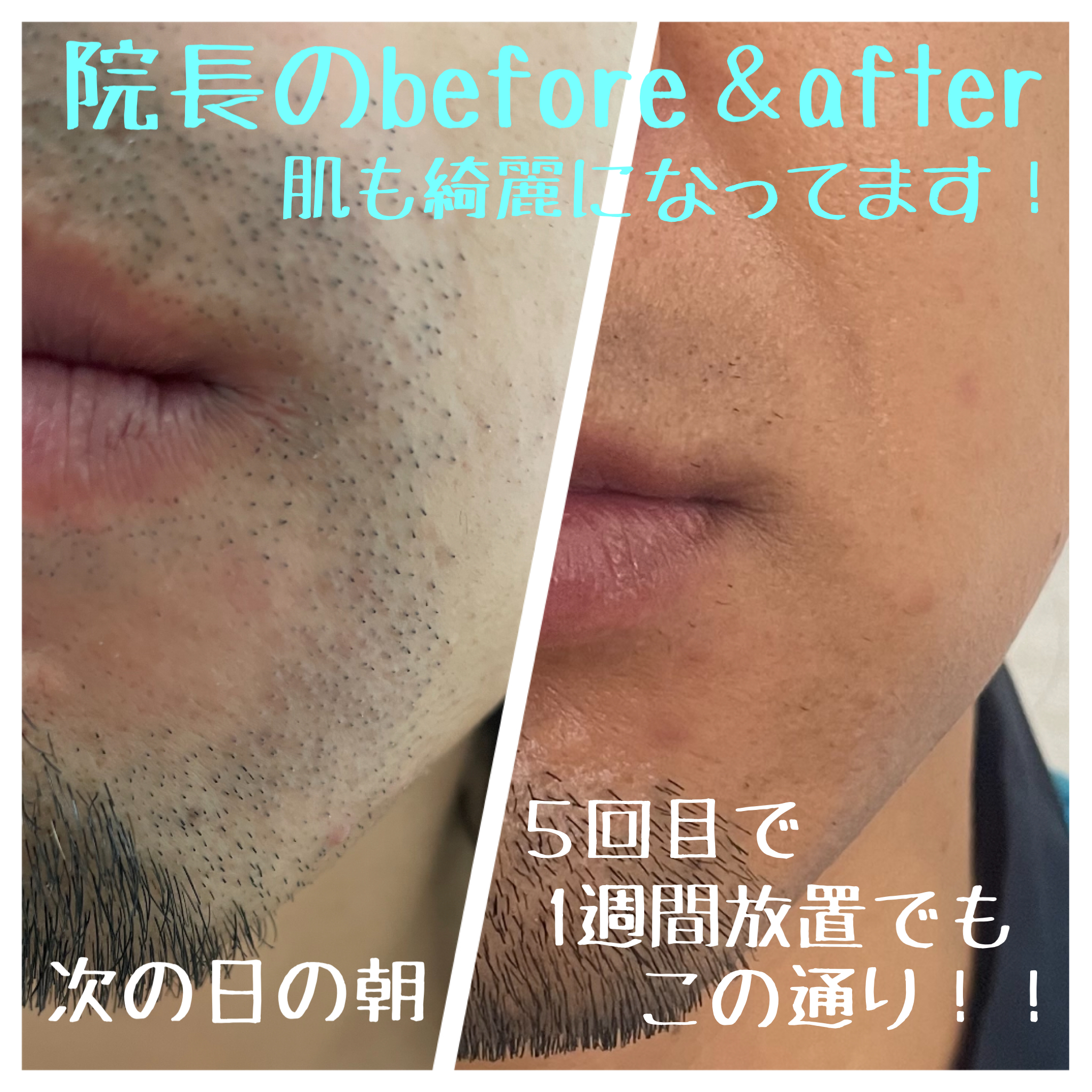 院長ヒゲ