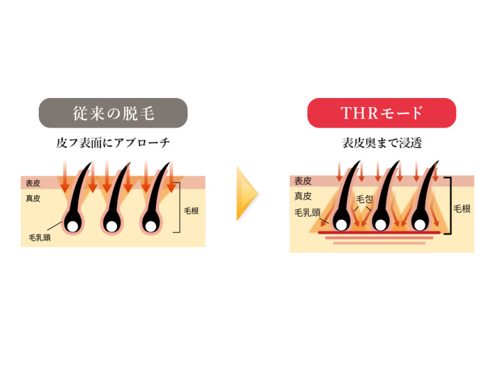 従来の脱毛
